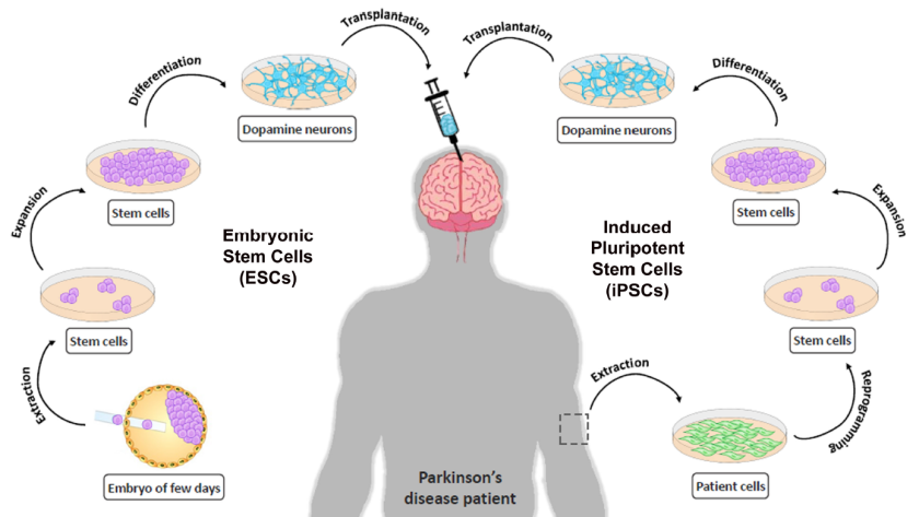 parkinson's disease stem cells therapy hydrogel hospitals