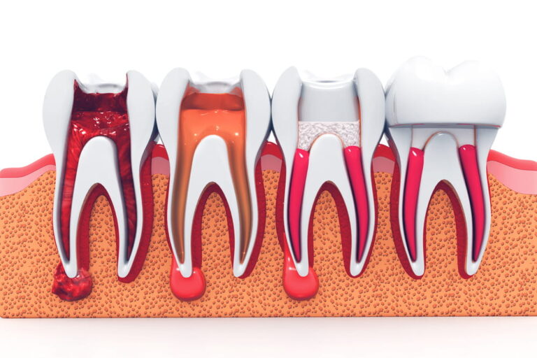 A Complete Guide To A Root Canal Treatment Healthcare Business Club