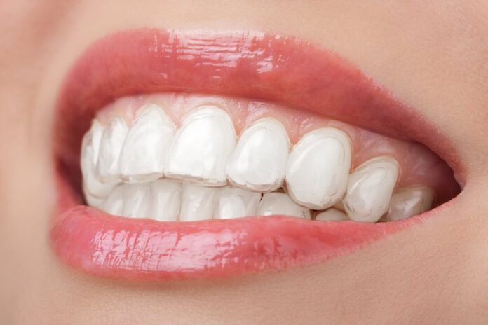 Clear Dental Retainers: An Easy And Affordable Way To Boost Your Smile