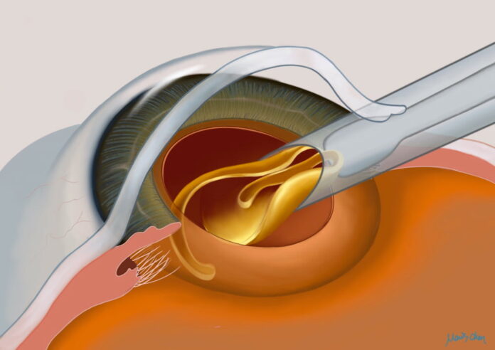 4 Frequent Questions People Have Cataract Surgery