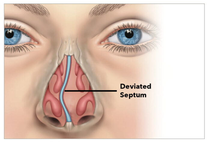 Rhinoplasty for Breathing Function Fixing a Deviated Septum