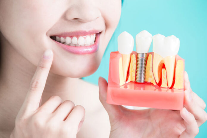 4 Teeth Questions You Should ask about Implantation