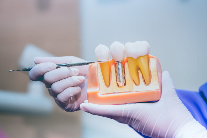 How To Keep Your Dental Implants Clean And Natural-Looking