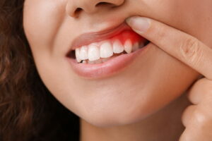 The Different Treatment Options For Periodontal Disease