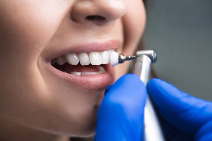 Achieving Perfect Dental Polish: A Guide to Selecting the Right Polishers