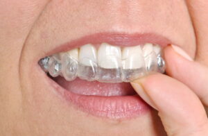 Diverse Treatment Plans and Costs of Invisalign for a Flawless Smile