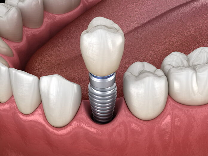 Learn More About The Process of Getting Dental Implants