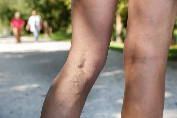 Tips for Managing Pain and Discomfort from Varicose Veins
