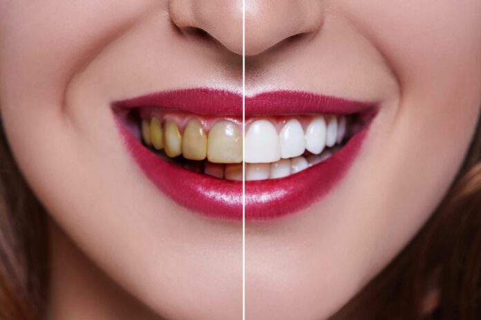 How to Whiten Your Teeth at Home Natural and Effective Methods