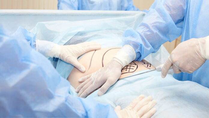 Unveiling Liposuction Process, Benefits, And Potential Risks