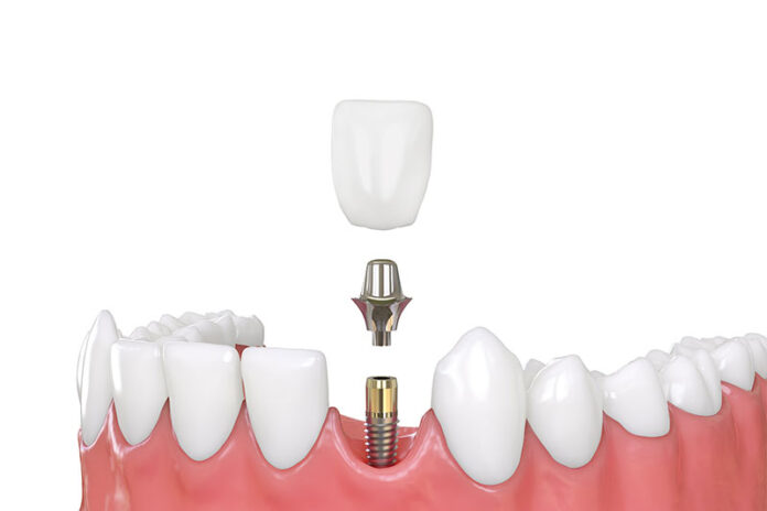 What Are All On 4 Dental Implants and What Are the Benefits?