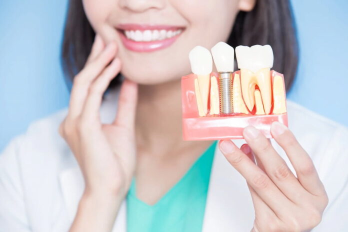 3 Questions to Ask Your Dentist Before Getting Implant Bridges