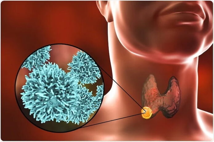 Thyroid Cancer: Risk Factors, Symptoms, and Treatment Options