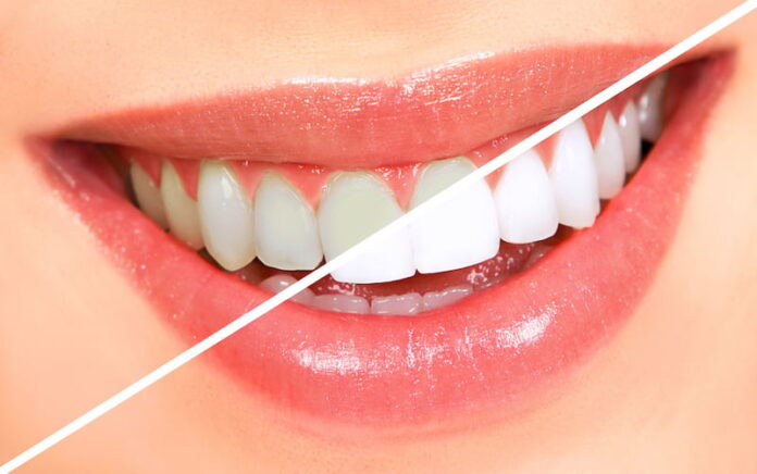 Is Teeth Whitening Right For You