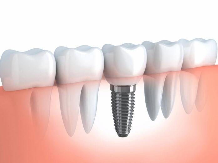 Top 4 Reasons To Get Dental Implants