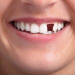 The Cost and Financial Considerations of Front Teeth Replacement