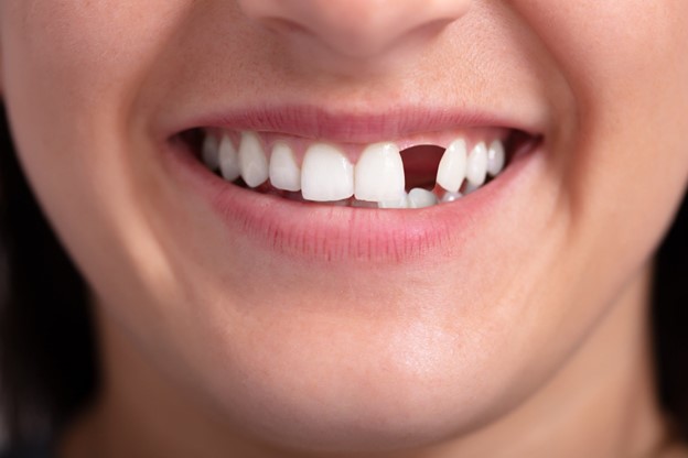The Cost and Financial Considerations of Front Teeth Replacement