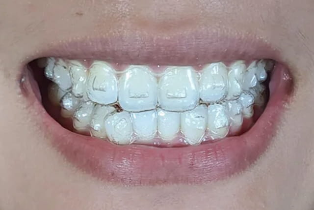 Smile Makeover: Transform Your Teeth with Invisalign in San Francisco