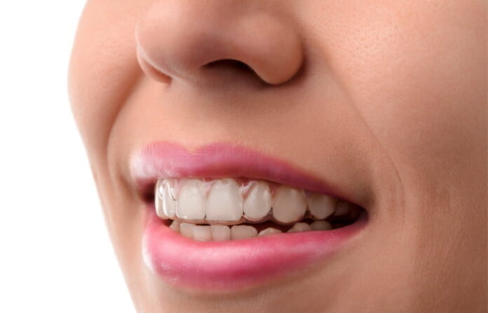 How To Get An Invisalign Treatment At Affordable Prices?