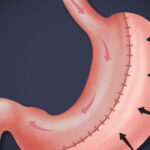 What Is a Vertical Sleeve Gastrectomy?