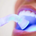 The Ultimate Guide to Teeth Whitening and Dental Bleaching