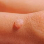 Symptoms And Causes Of Warts And Treatment