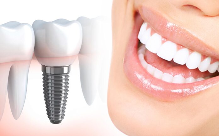 The Power of Dental Implants Revolutionize Your Smile: The Power of Dental Implants
