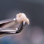 Discover Comfort: Pain-Free Wisdom Teeth Extraction