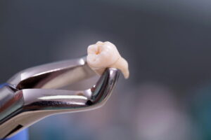 Discover Comfort: Pain-Free Wisdom Teeth Extraction