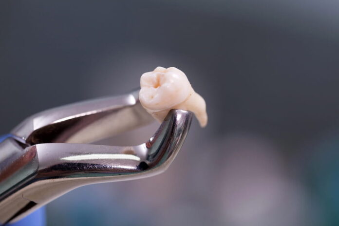 Discover Comfort: Pain-Free Wisdom Teeth Extraction