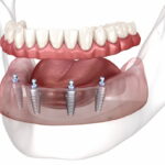 How All-on-4 Can Transform Your Smile (and Confidence)