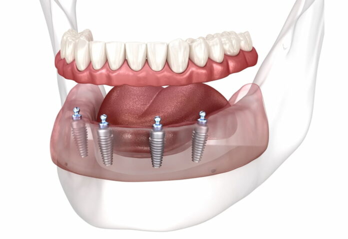 How All-on-4 Can Transform Your Smile (and Confidence). (1) How All-on-4 Can Transform Your Smile (and Confidence)