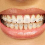 Coquitlam Braces