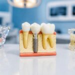 What Makes Permanent Tooth Replacement A Life-Changing Option