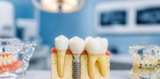 What Makes Permanent Tooth Replacement A Life-Changing Option